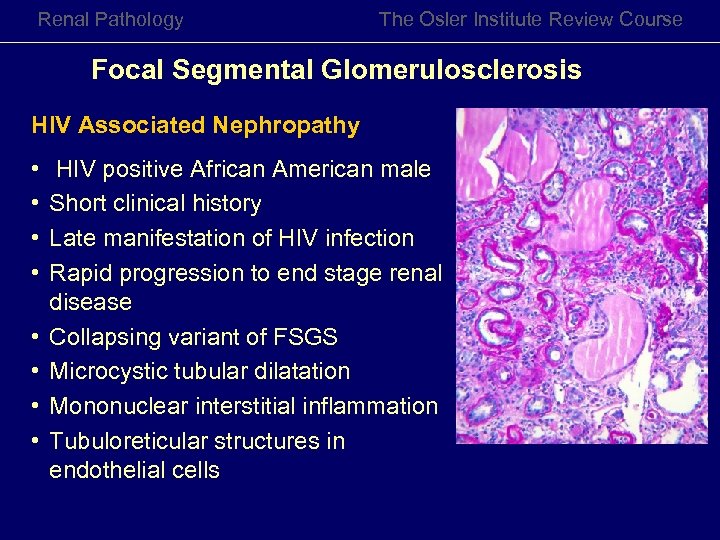 Renal Pathology The Osler Institute Review Course Focal Segmental Glomerulosclerosis HIV Associated Nephropathy •