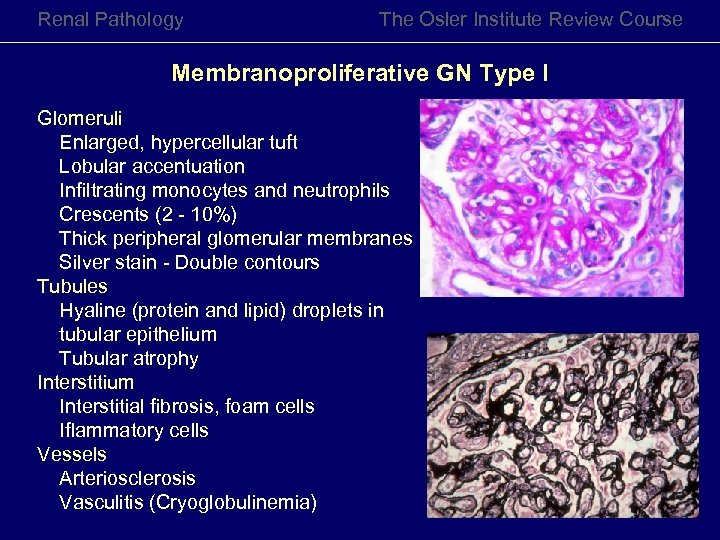 Renal Pathology The Osler Institute Review Course Membranoproliferative GN Type I Glomeruli Enlarged, hypercellular