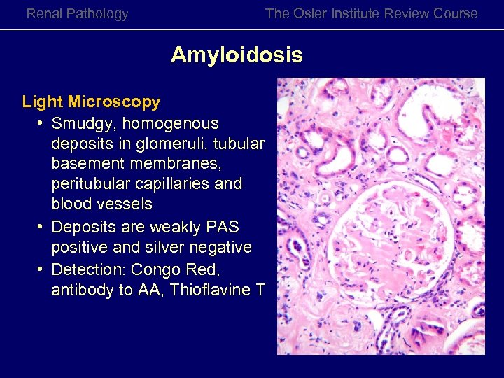 Renal Pathology The Osler Institute Review Course Amyloidosis Light Microscopy • Smudgy, homogenous deposits