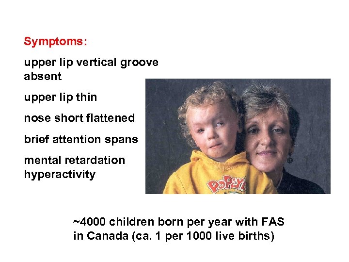 Symptoms: upper lip vertical groove absent upper lip thin nose short flattened brief attention