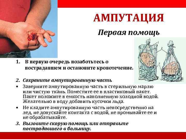  АМПУТАЦИЯ Первая помощь 1. В первую очередь позаботьтесь о пострадавшем и остановите кровотечение.