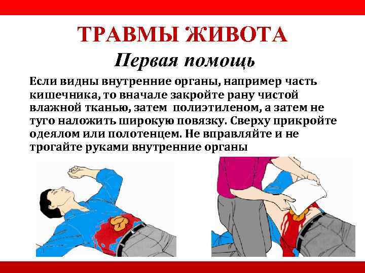 ТРАВМЫ ЖИВОТА Первая помощь Если видны внутренние органы, например часть кишечника, то вначале закройте