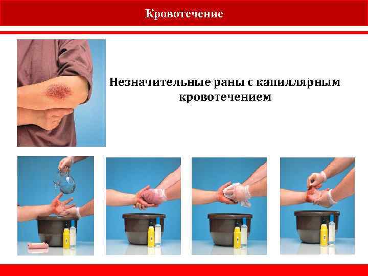Кровотечение Незначительные раны с капиллярным кровотечением 