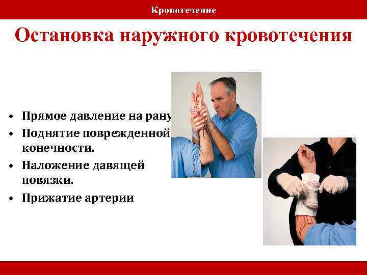 Кровотечение Остановка наружного кровотечения • Прямое давление на рану. • Поднятие поврежденной конечности. •