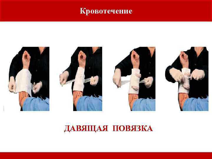 Кровотечение ДАВЯЩАЯ ПОВЯЗКА 