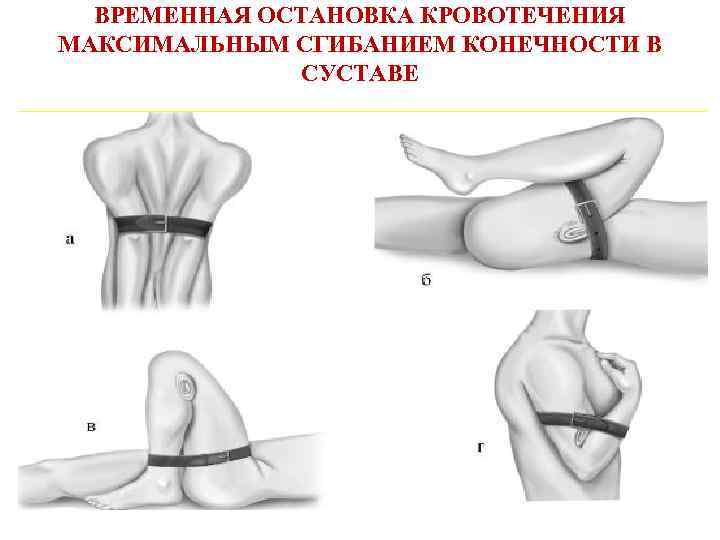 ВРЕМЕННАЯ ОСТАНОВКА КРОВОТЕЧЕНИЯ МАКСИМАЛЬНЫМ СГИБАНИЕМ КОНЕЧНОСТИ В СУСТАВЕ 