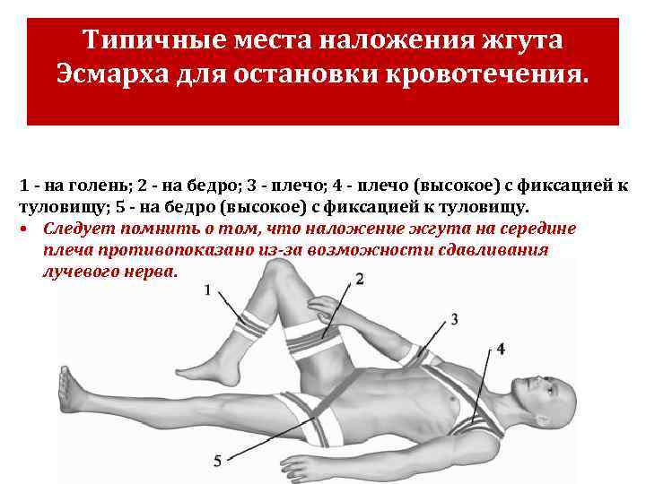 Типичные места наложения жгута Эсмарха для остановки кровотечения. 1 - на голень; 2 -