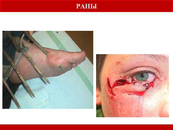 РАНЫ f. how to recognise and treat clinical shock 