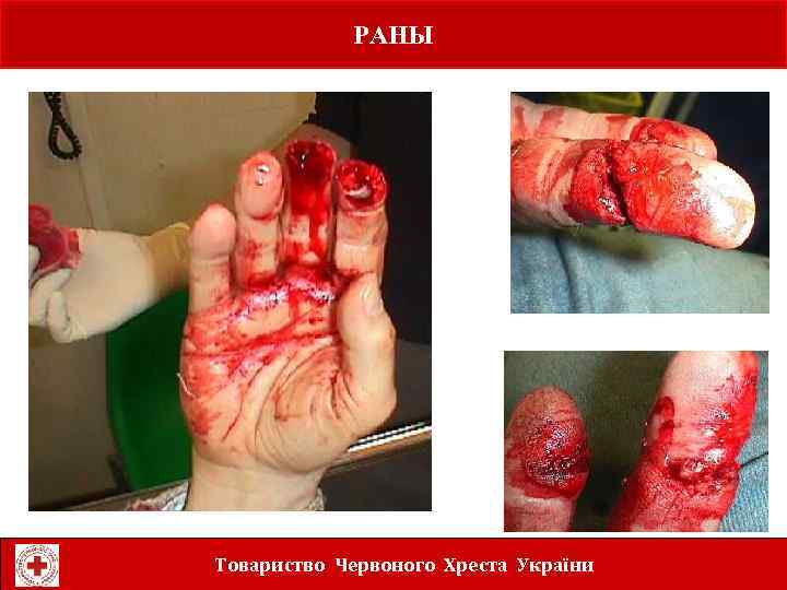РАНЫ Laceration to fingers Товариство Червоного Хреста України 