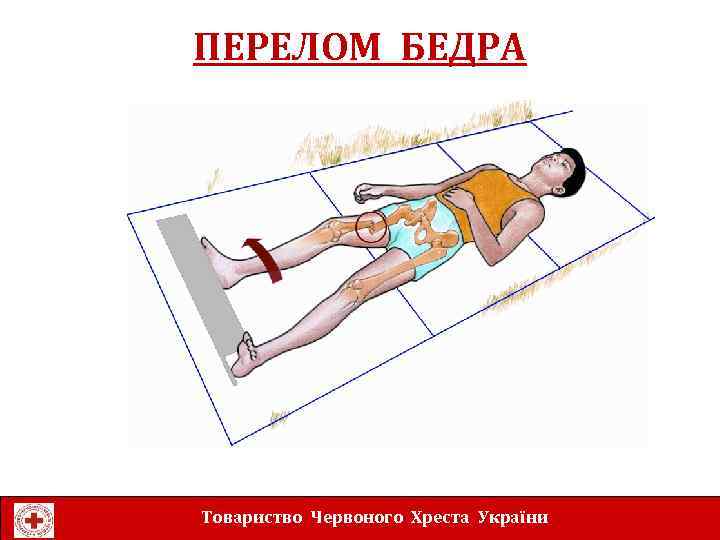 ПЕРЕЛОМ БЕДРА Товариство Червоного Хреста України 
