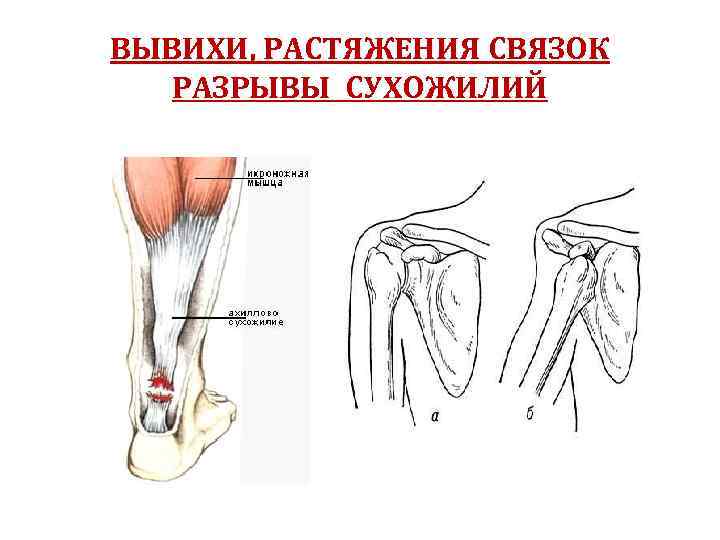 ВЫВИХИ, РАСТЯЖЕНИЯ СВЯЗОК РАЗРЫВЫ СУХОЖИЛИЙ 