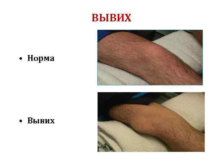 ВЫВИХ • Норма • Вывих 