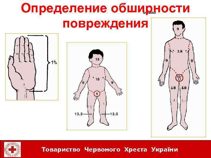 Определение обширности повреждения ожоги Товариство Червоного Хреста України 