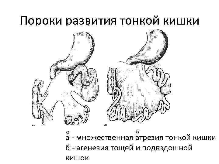 Пороки развития тонкой кишки а - множественная атрезия тонкой кишки б - агенезия тощей