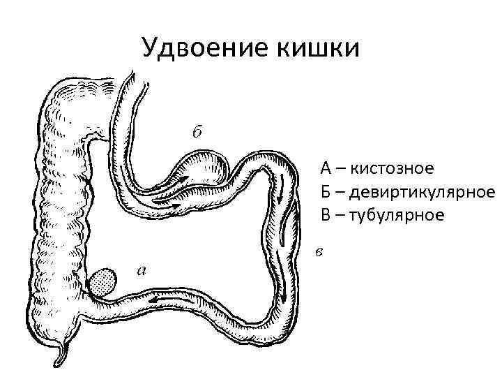 Удвоение кишки А – кистозное Б – девиртикулярное В – тубулярное 