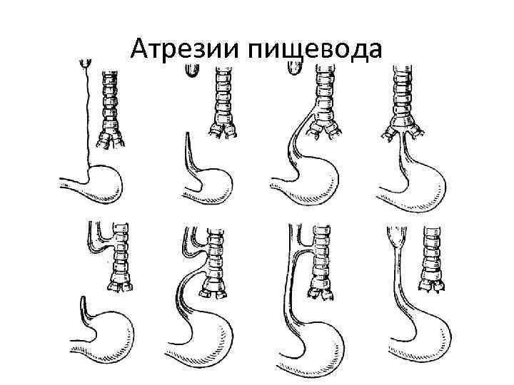 Атрезии пищевода 