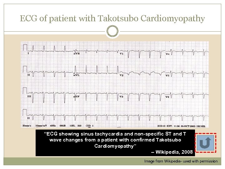 ECG of patient with Takotsubo Cardiomyopathy “ECG showing sinus tachycardia and non-specific ST and