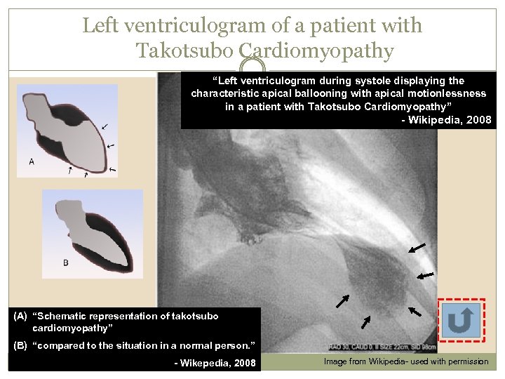 Left ventriculogram of a patient with Takotsubo Cardiomyopathy __ “Left ventriculogram during systole displaying