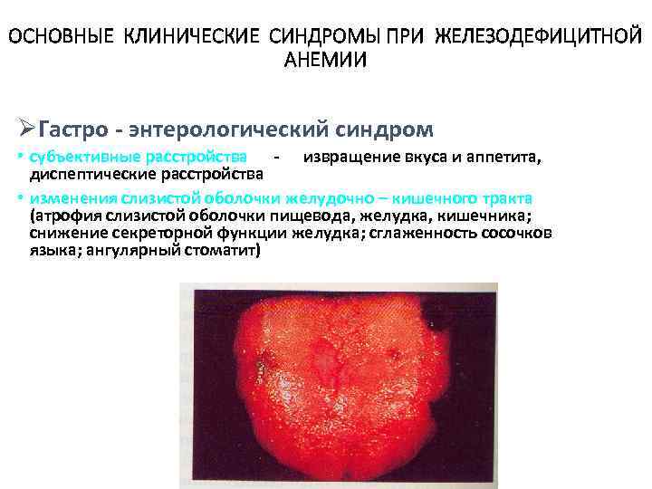 ОСНОВНЫЕ КЛИНИЧЕСКИЕ СИНДРОМЫ ПРИ ЖЕЛЕЗОДЕФИЦИТНОЙ АНЕМИИ ØГастро - энтерологический синдром • субъективные расстройства -