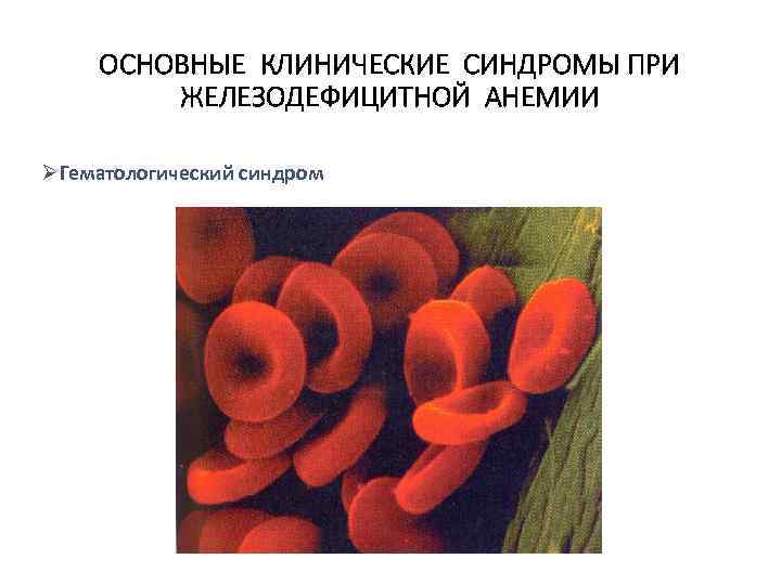 ОСНОВНЫЕ КЛИНИЧЕСКИЕ СИНДРОМЫ ПРИ ЖЕЛЕЗОДЕФИЦИТНОЙ АНЕМИИ ØГематологический синдром 