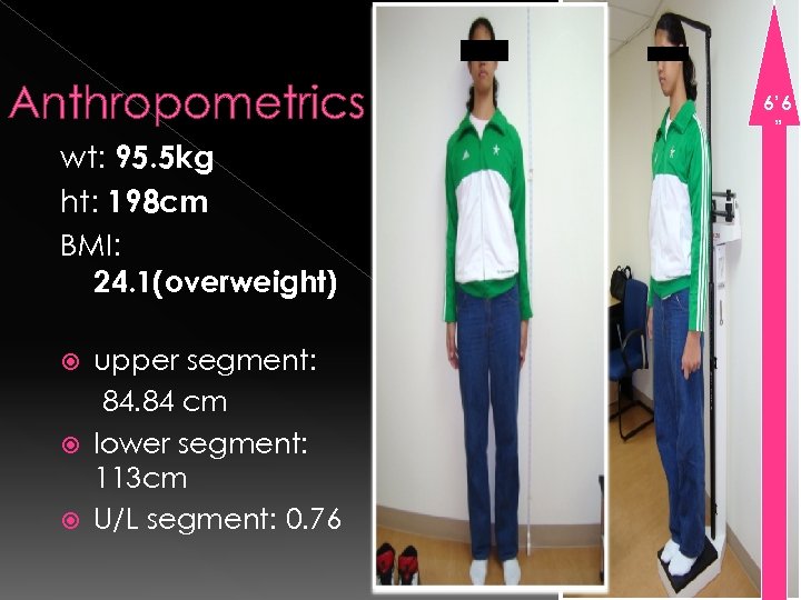 Anthropometrics wt: 95. 5 kg ht: 198 cm BMI: 24. 1(overweight) upper segment: 84.