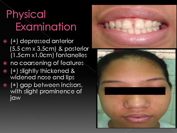 Physical Examination (+) depressed anterior (5. 5 cm x 3. 5 cm) & posterior