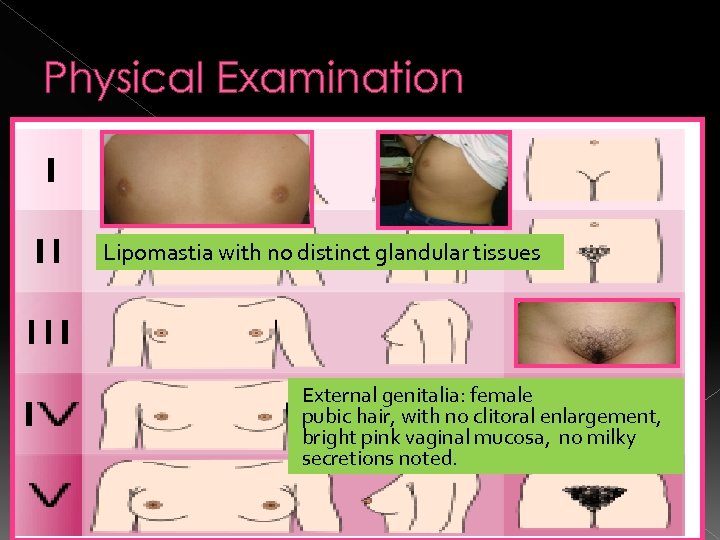 Physical Examination Lipomastia with no distinct glandular tissues External genitalia: female pubic hair, with