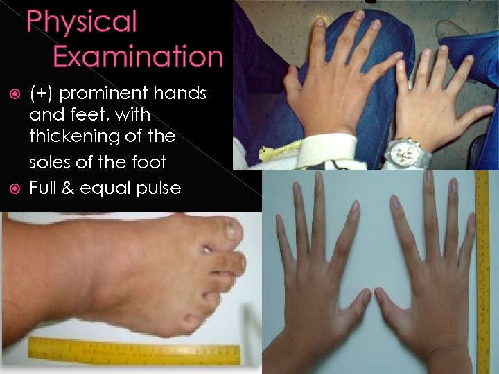 Physical Examination (+) prominent hands and feet, with thickening of the soles of the