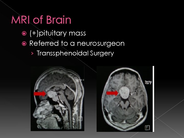 MRI of Brain (+)pituitary mass Referred to a neurosurgeon › Transsphenoidal Surgery 