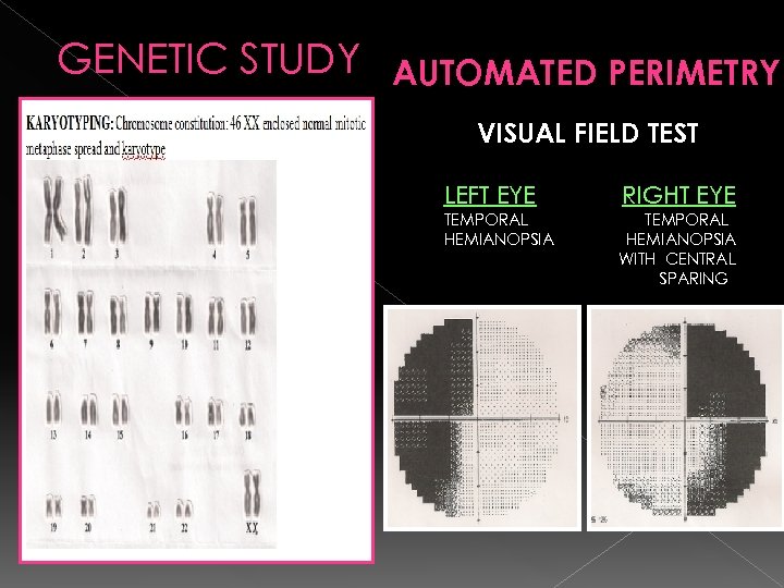 GENETIC STUDY AUTOMATED PERIMETRY VISUAL FIELD TEST LEFT EYE RIGHT EYE TEMPORAL HEMIANOPSIA WITH