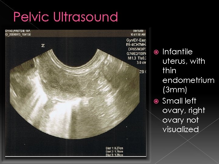 Pelvic Ultrasound Infantile uterus, with thin endometrium (3 mm) Small left ovary, right ovary