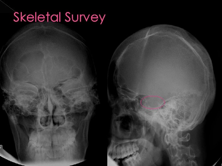 Skeletal Survey 