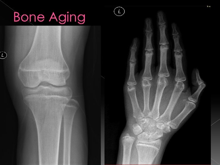 Bone Aging 