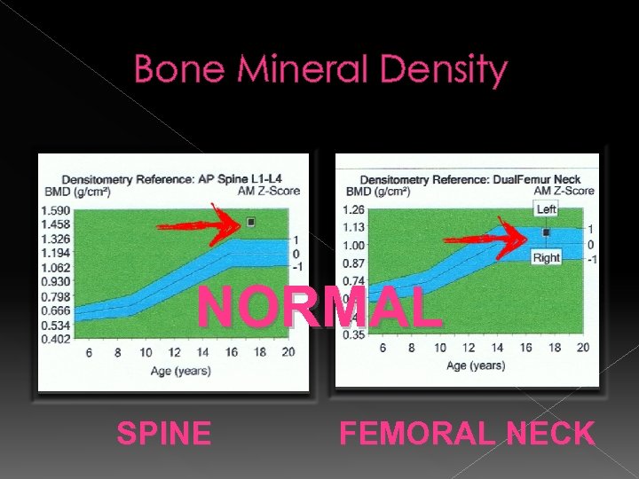 Bone Mineral Density NORMAL SPINE FEMORAL NECK 