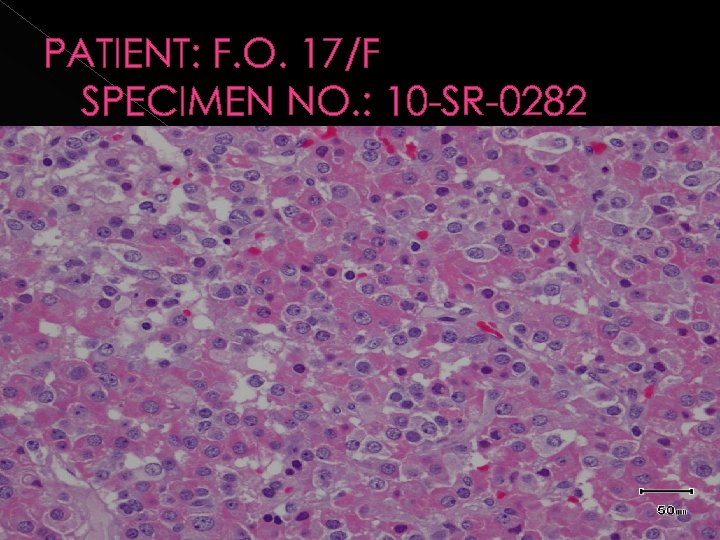 PATIENT: F. O. 17/F SPECIMEN NO. : 10 -SR-0282 