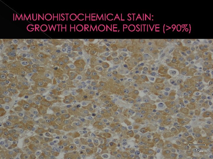 IMMUNOHISTOCHEMICAL STAIN: GROWTH HORMONE, POSITIVE (>90%) 