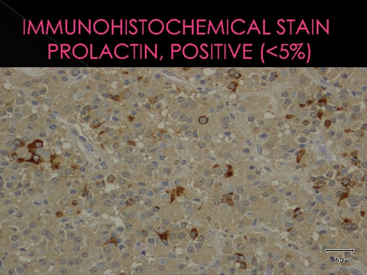 IMMUNOHISTOCHEMICAL STAIN PROLACTIN, POSITIVE (<5%) 