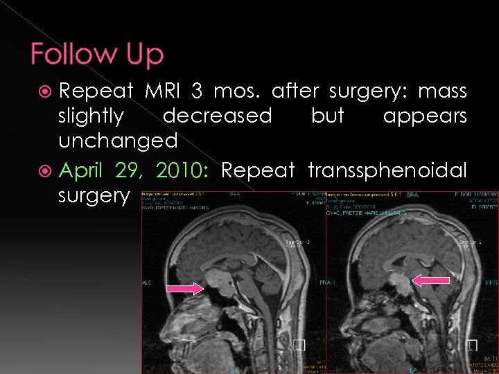 Follow Up Repeat MRI 3 mos. after surgery: mass slightly decreased but appears unchanged