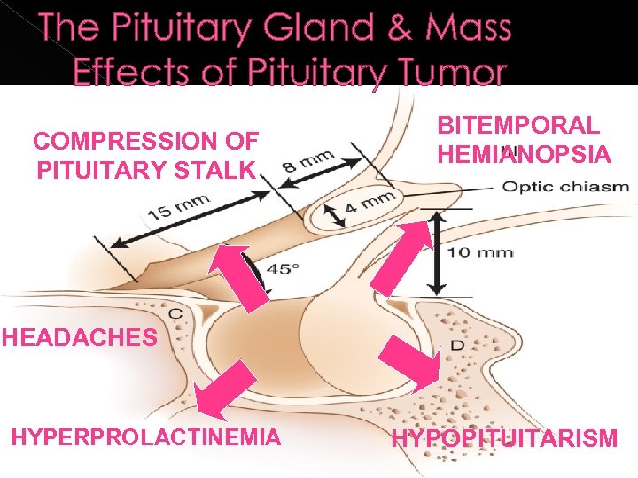 The Pituitary Gland & Mass Effects of Pituitary Tumor COMPRESSION OF PITUITARY STALK BITEMPORAL