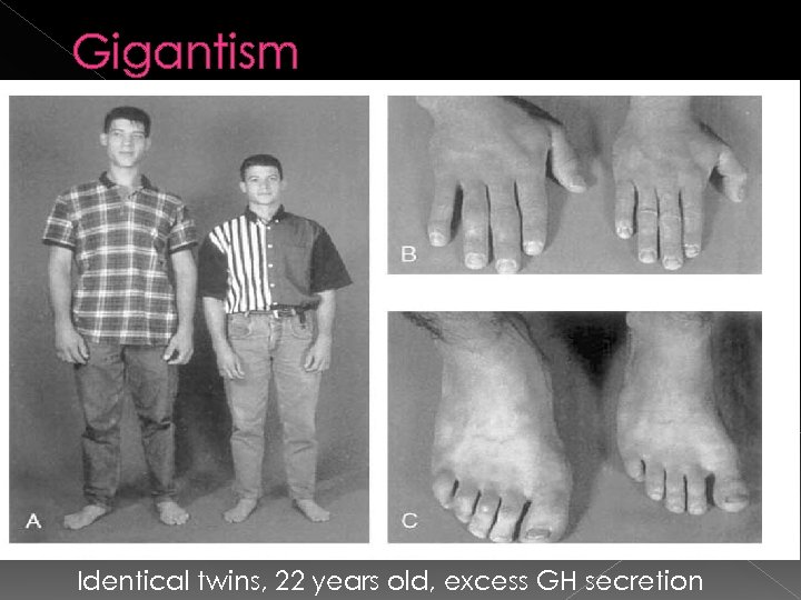 Gigantism Identical twins, 22 years old, excess GH secretion 