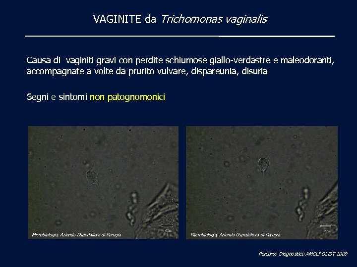VAGINITE da Trichomonas vaginalis Causa di vaginiti gravi con perdite schiumose giallo-verdastre e maleodoranti,