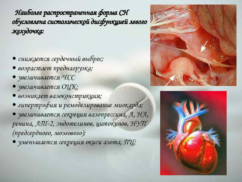 Наиболее распространенная форма СН обусловлена систолической дисфункцией левого желудочка: • снижается сердечный выброс; •