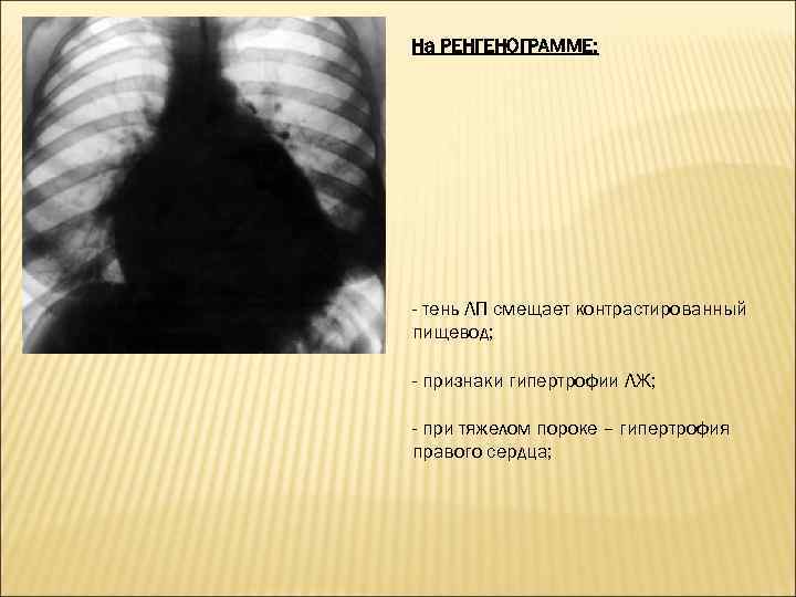 На РЕНГЕНОГРАММЕ: - тень ЛП смещает контрастированный пищевод; - признаки гипертрофии ЛЖ; - при