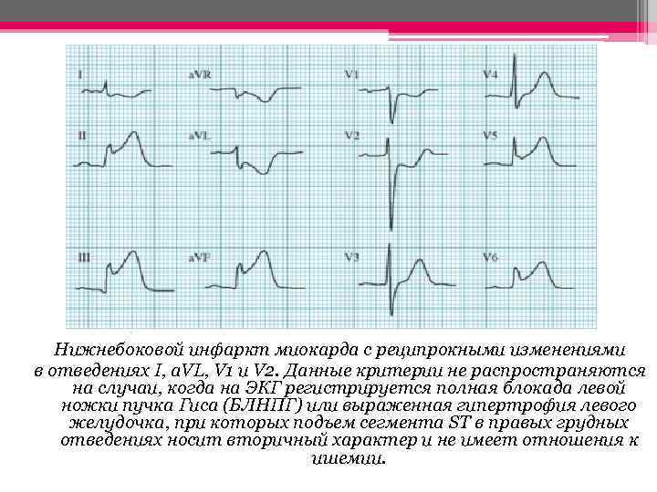 Нижнебоковой инфаркт миокарда с реципрокными изменениями в отведениях I, a. VL, V 1 и