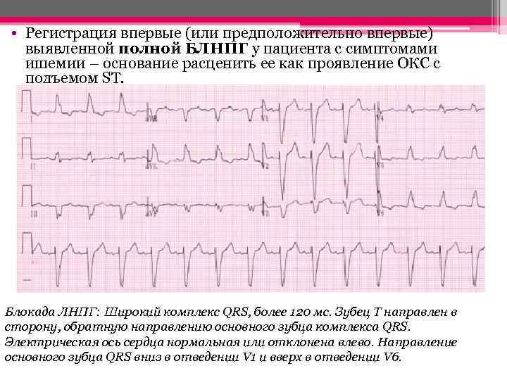  • Регистрация впервые (или предположительно впервые) выявленной полной БЛНПГ у пациента с симптомами