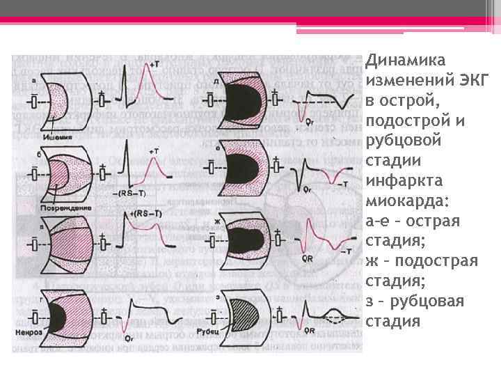 Динамика изменений ЭКГ в острой, подострой и рубцовой стадии инфаркта миокарда: а–е – острая