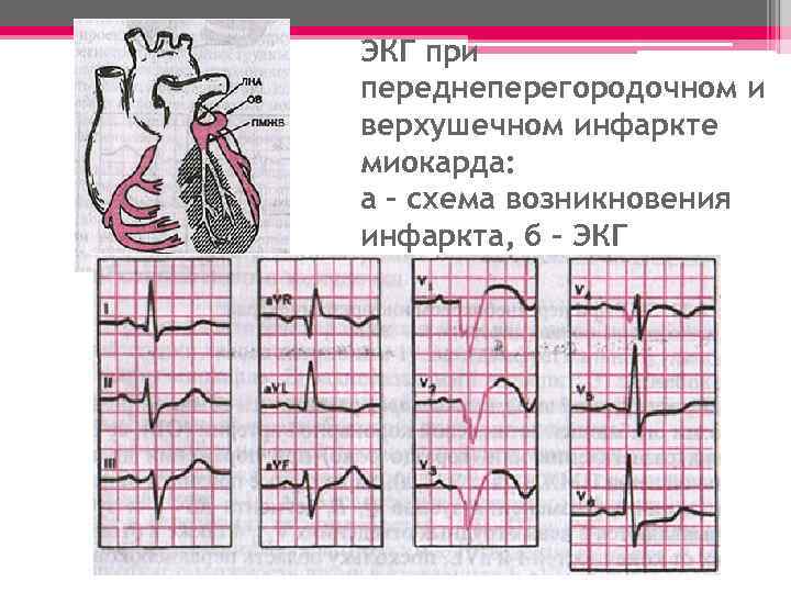 ЭКГ при переднеперегородочном и верхушечном инфаркте миокарда: а – схема возникновения инфаркта, б –