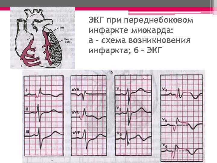ЭКГ при переднебоковом инфаркте миокарда: а – схема возникновения инфаркта; б – ЭКГ 