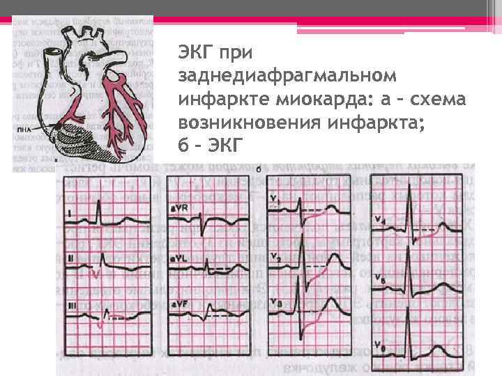 ЭКГ при заднедиафрагмальном инфаркте миокарда: а – схема возникновения инфаркта; б – ЭКГ 