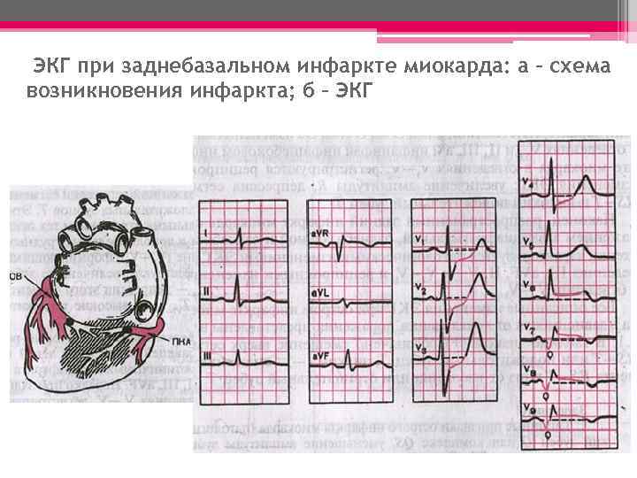  ЭКГ при заднебазальном инфаркте миокарда: а – схема возникновения инфаркта; б – ЭКГ